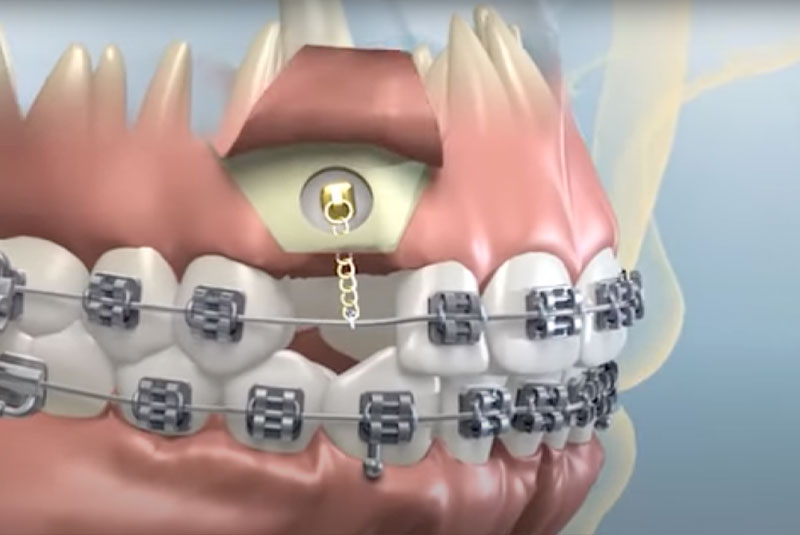 close up of dental demonstration of braces graphic