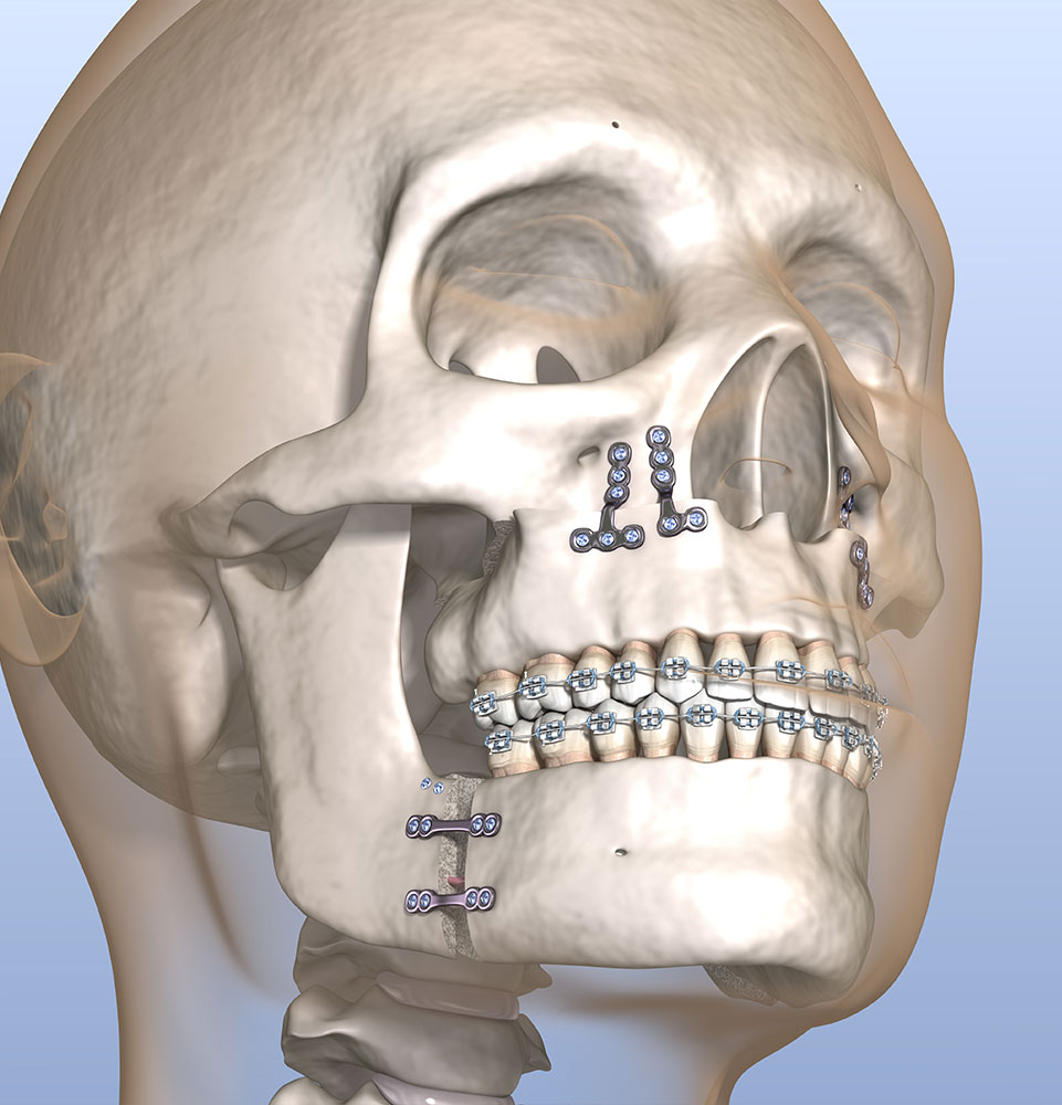 model of a skull that has gone through jaw surgery