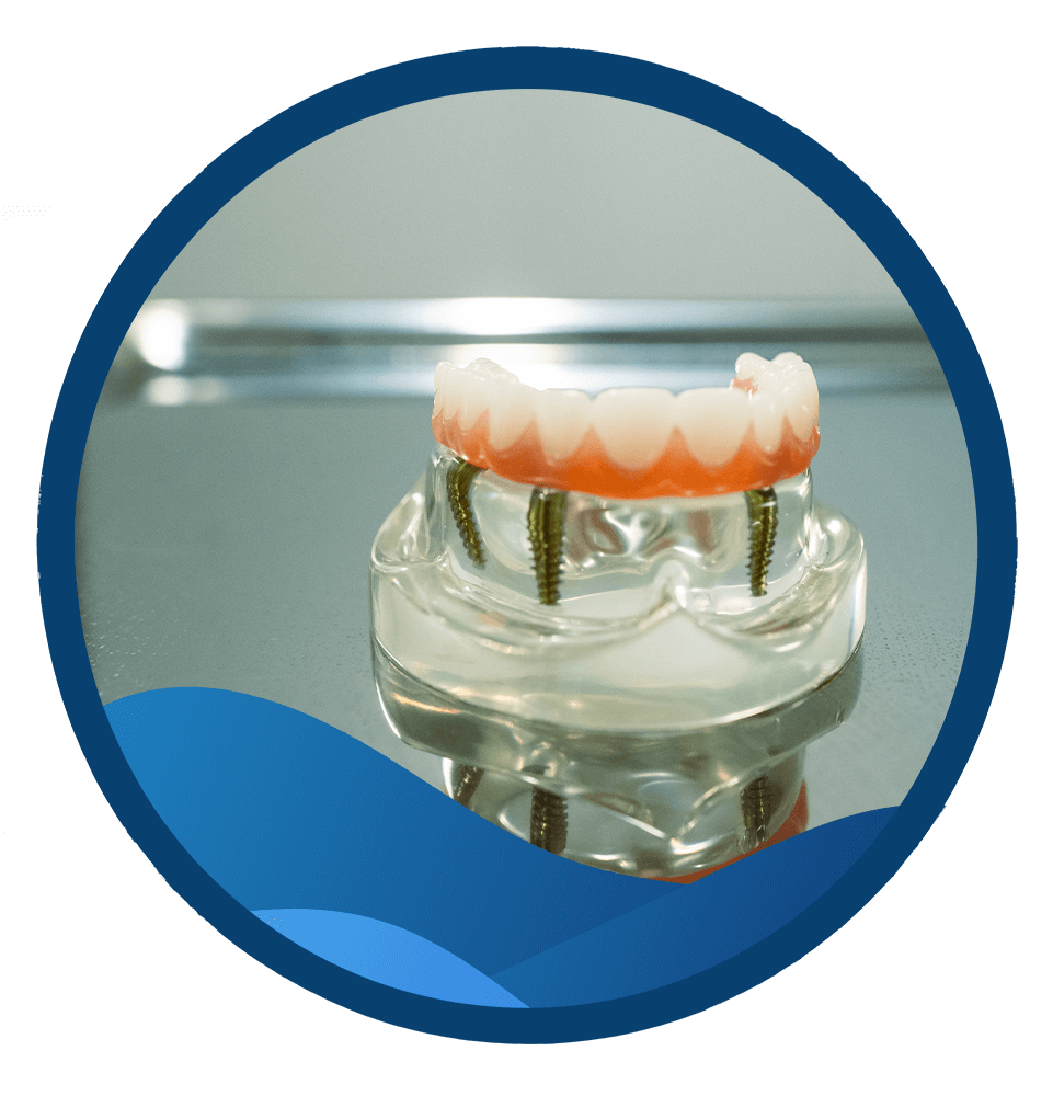 model of implants