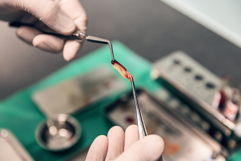 Platelet Rich Fibrin